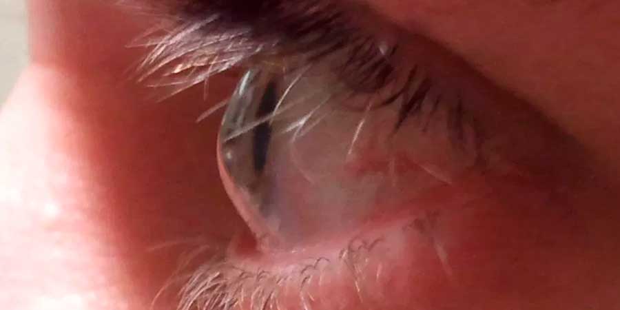 ceratocone
